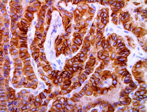 IHC of c-Met on an FFPE Papillary Thyroid Carcinoma Tissue